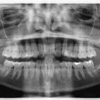 Adult pano xray for seeing all the teeth at the same time.