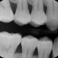 Digital Bitewing Xray for seeing in between the teeth.