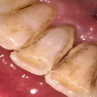 An intraoral photo showing calculus (tartar) and stain on the backside of the lower front teeth.