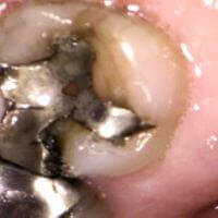 An old amalgam filling that needs replacement.